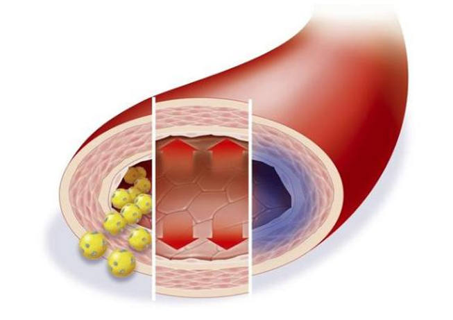 低密度膽固醇超標(biāo)，多久會(huì)影響血管健康？來(lái)看看鹽城康復(fù)醫(yī)院醫(yī)生怎么說(shuō)